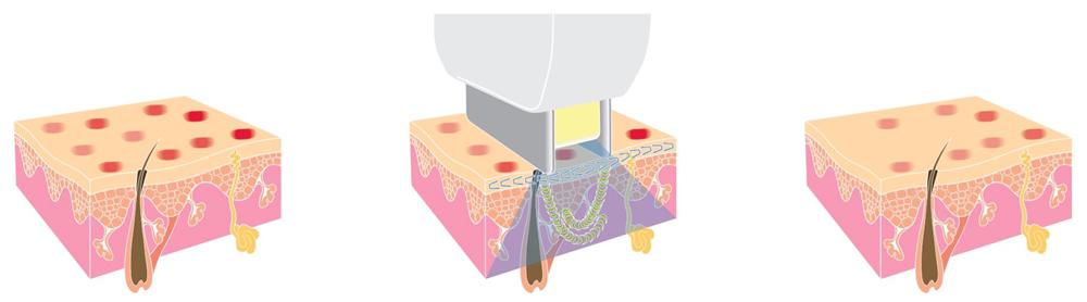 Acne Laser